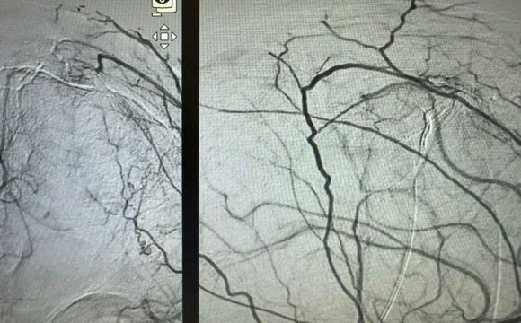 Presurgical Embolization of Brain Meningiomas