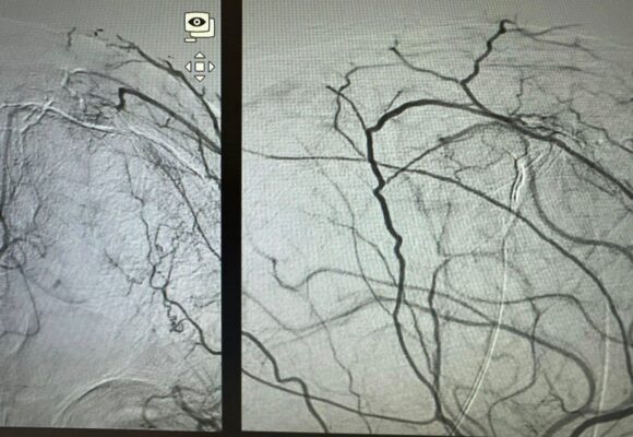 Embolization of Brain Meningiomas-7 Presurgical Embolization of Brain Meningiomas