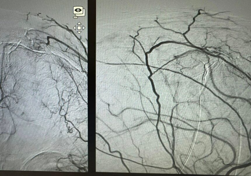 Presurgical Embolization of Brain Meningiomas