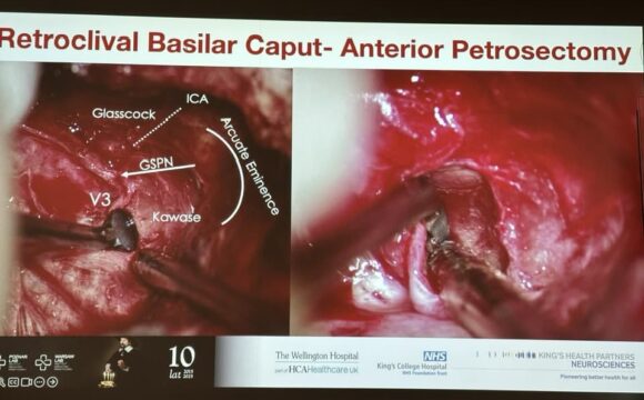 Skull base 🧠 tumor & aneurysm surgical training under 3D exoscopic vision