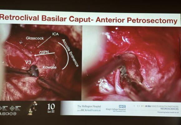 Skull-base-4 Skull base 🧠 tumor & aneurysm surgical training under 3D exoscopic vision