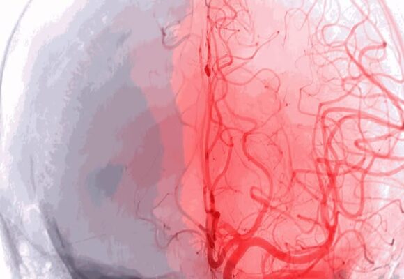 3d-Athens-Cerebral-2 3rd Athens Cerebral vascular and endovascular (24-25 April 2026 Athens)
